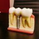 How Dental Implants Restore Confidence In Everyday Life