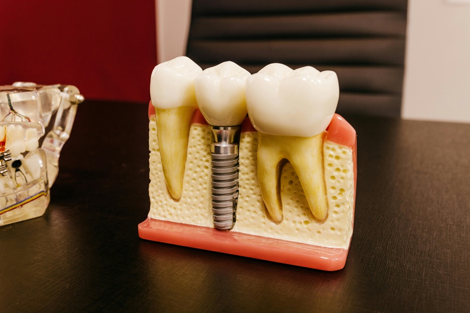How Dental Implants Restore Confidence In Everyday Life